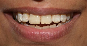 Smile Restoration with Porcelain Laminates