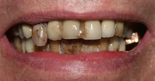 Full Mouth Rehabilitation