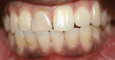 Teeth Whitening