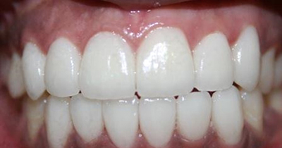 Teeth Whitening 2