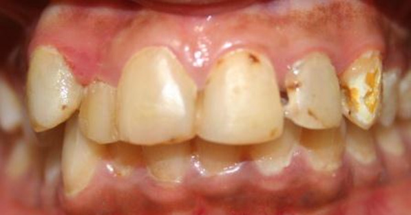 Oral Rehabilitation and Alignment