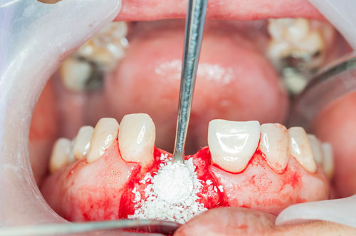 Dental Bone Grafting