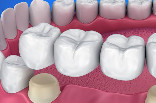 3 tooth bridge