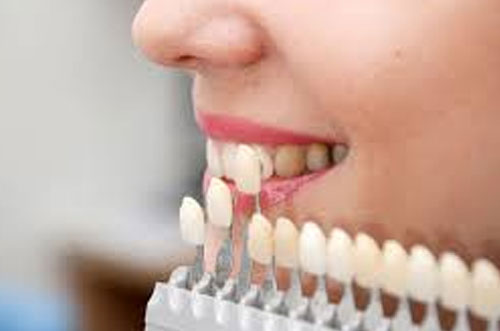 Tooth Crown - Veneer