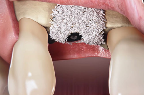 Guided Gum Tissue Restoration