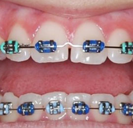 Growth Modulation Braces