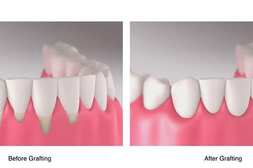 Tissue Grafting Surgery