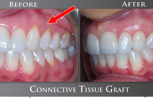 Tissue Grafting
