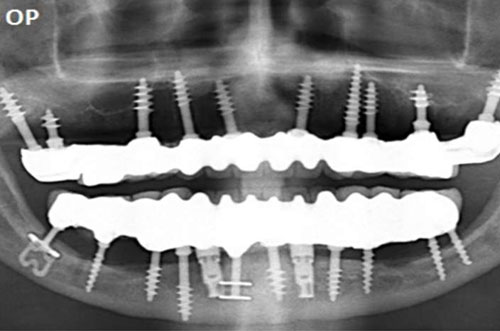 Basal Implants