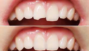 Cracked Tooth Repair
