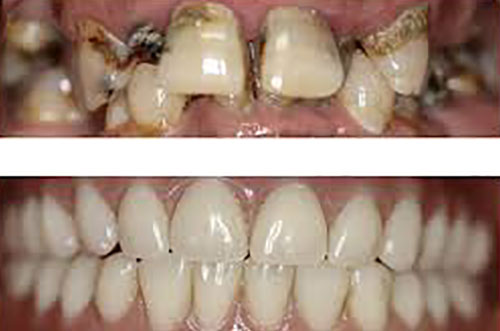 Full Mouth Smile Construction