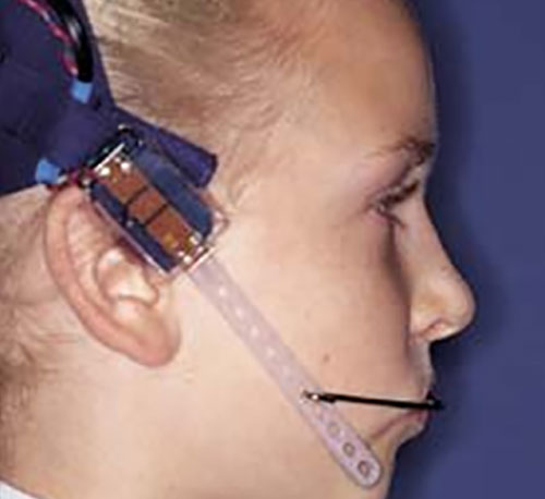 Headgear2 for Jaw Alignment