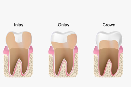 Inlays and Onlays