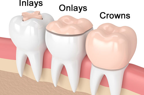 Inlays and Onlays Graphic