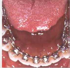 Lingual Braces