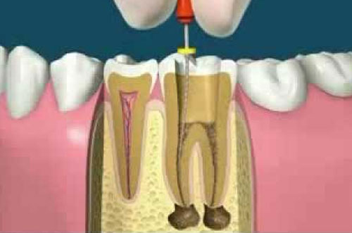 RCT diagram