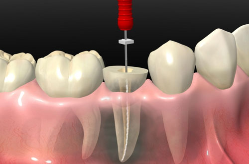 Root Canal Therapy