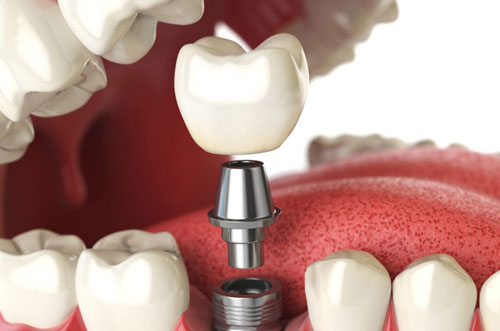 Single Tooth Dental Implants