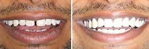 Smile Designing using Porcelain Veeners