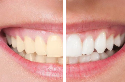 Teeth Cleaning Service