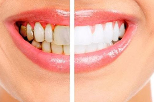 Teeth Whitening