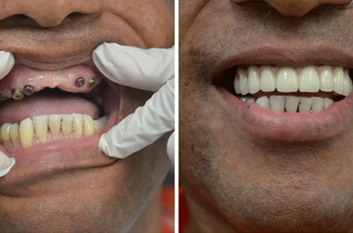 Tooth Extraction by a Dentist